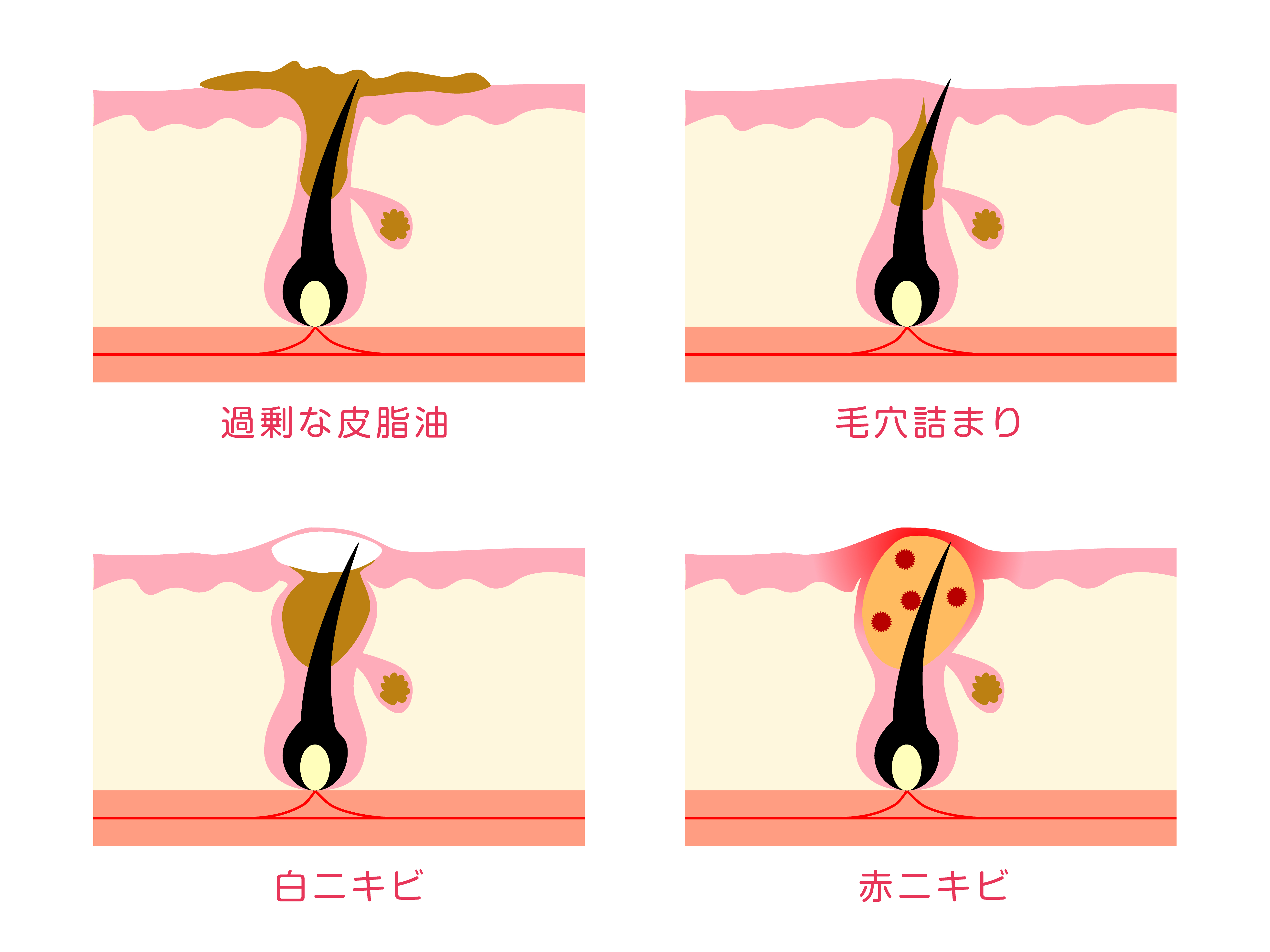 ニキビによる肌荒れの悩みとオリーブオイル 日本オリーブ公式通販